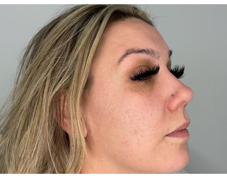 After Image: Potenza RF Microneedling: Acne Scars - right-front-oblique