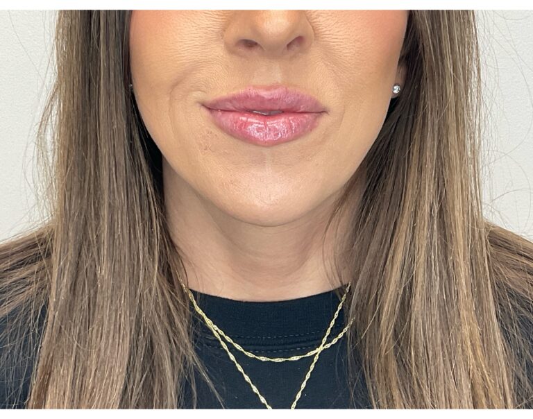 After Image: Lip Filler - front