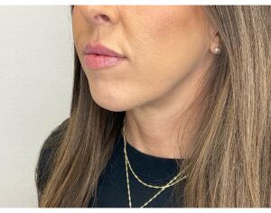 After Image: Lip Filler