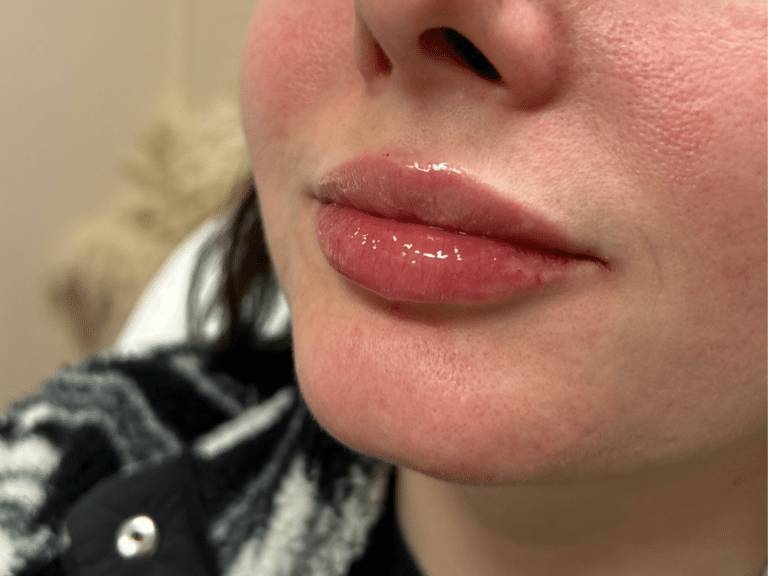 After Image: Lip Filler - left-front-oblique