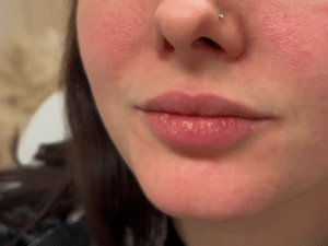 Before Image: Lip Filler