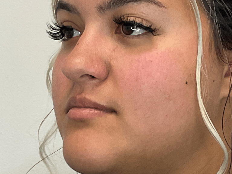 Before Image: Lip Filler - left-front-oblique