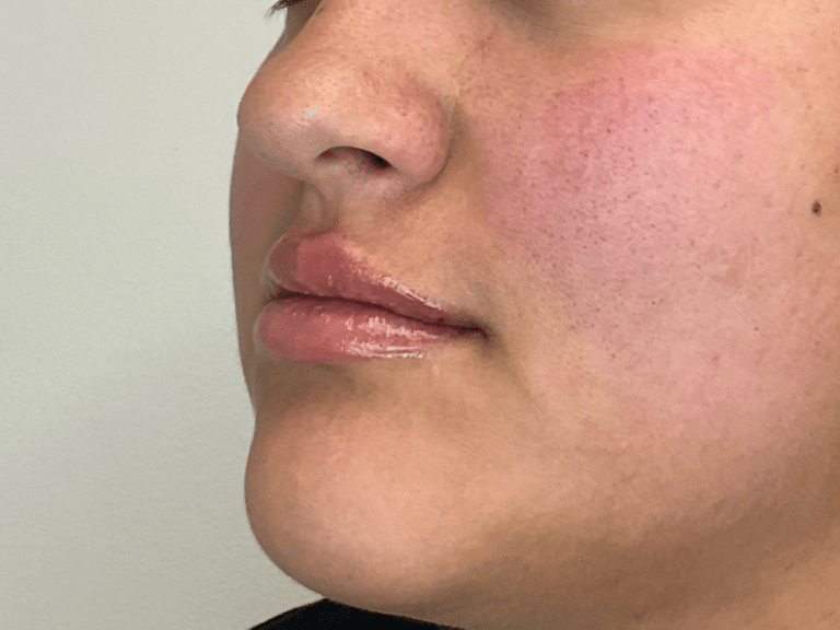 After Image: Lip Filler - left-front-oblique