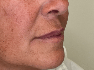 Before Image: Lip Filler