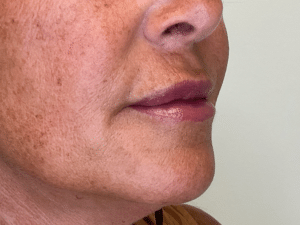After Image: Lip Filler