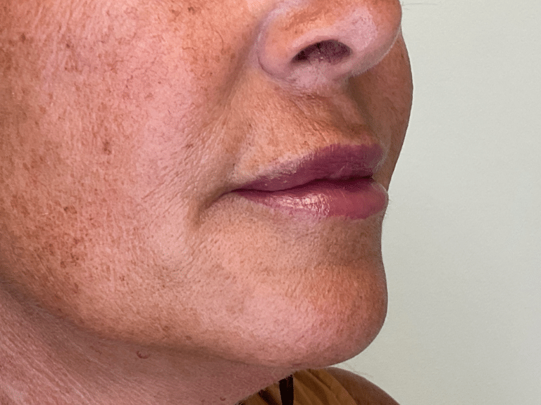 After Image: Lip Filler - right-front-oblique