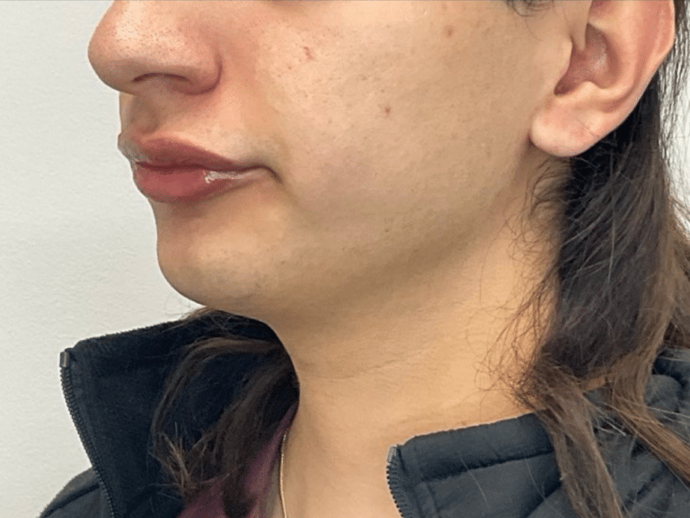 After Image: Laser Hair Reduction - left-front-oblique