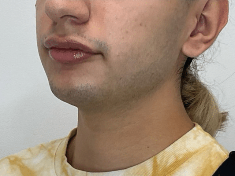 Before Image: Laser Hair Reduction - left-front-oblique
