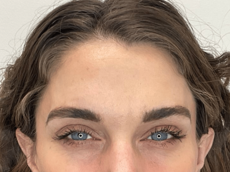 After Image: Botox -