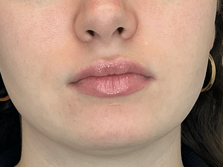 Before Image: Lip Filler - front