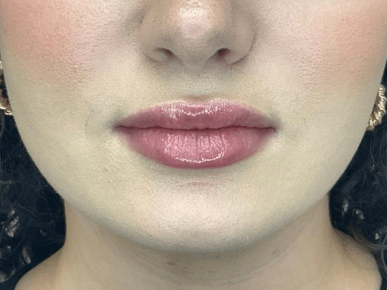 After Image: Lip Filler - front