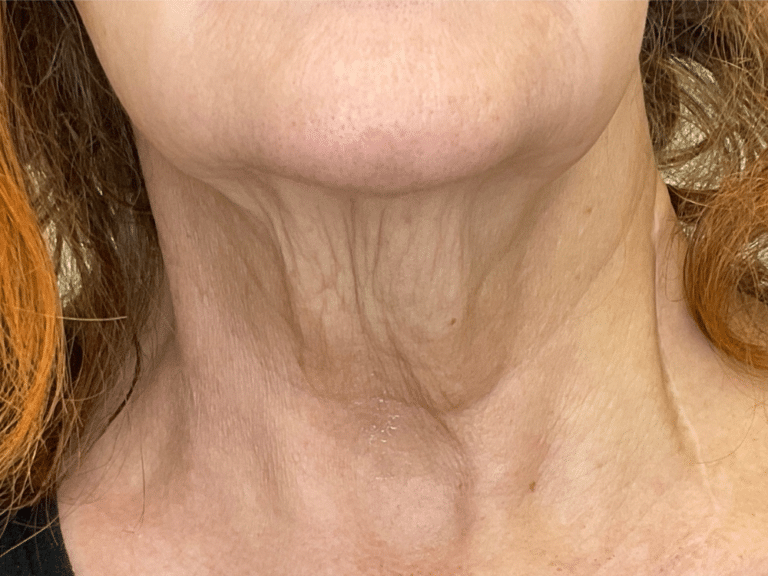 Before Image: Potenza RF Microneedling: Skin Laxity - front