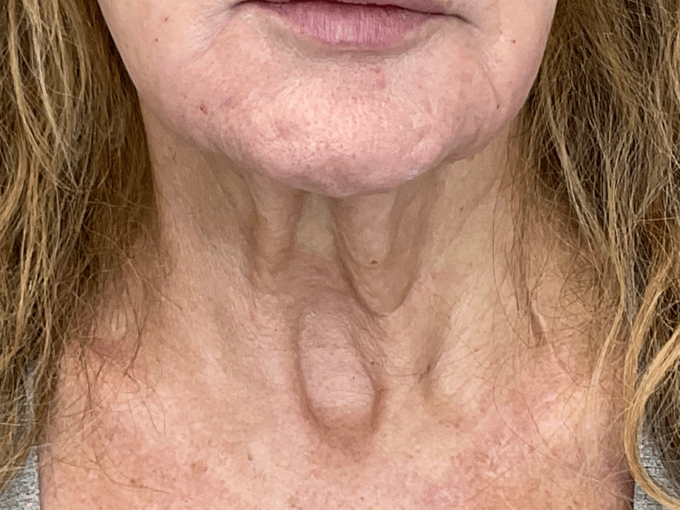 After Image: Potenza RF Microneedling: Skin Laxity - front
