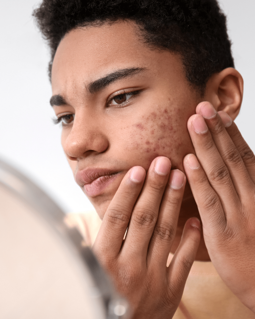 acne male