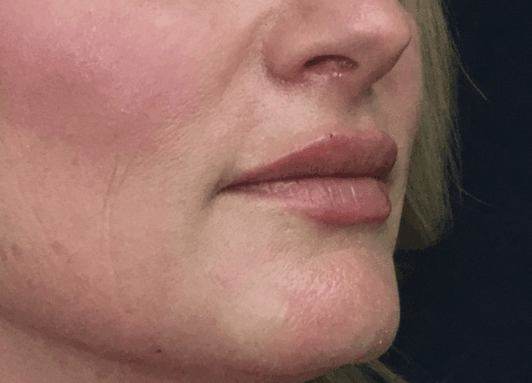 After Image: Lip Filler - right-front-oblique