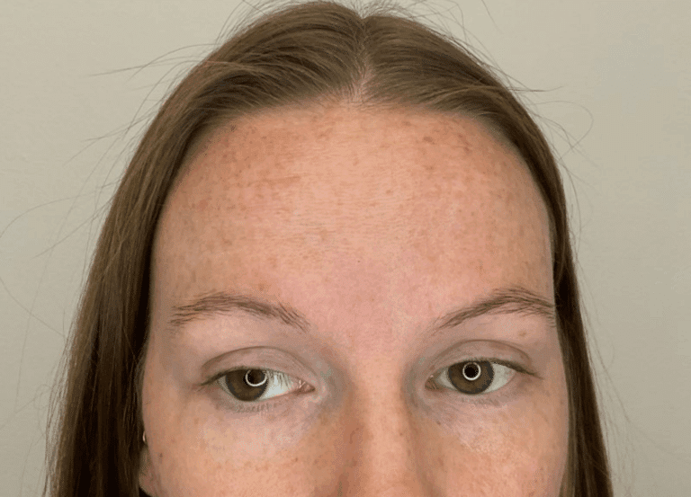 After Image: Botox - front