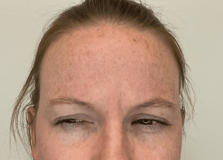 Before Image: Botox -