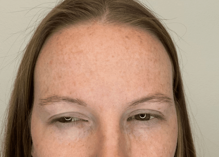 After Image: Botox -