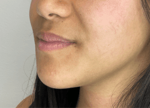 Before Image: Lip Filler
