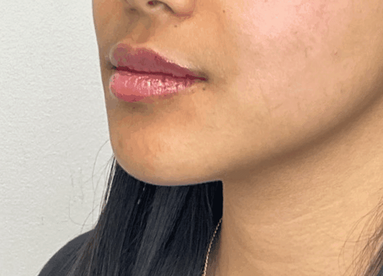 After Image: Lip Filler - left-front-oblique