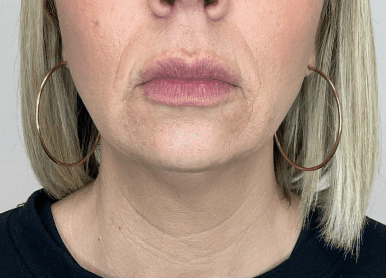 Before Image: Facial Fillers - front