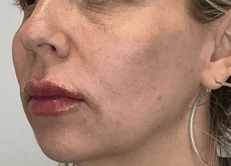 After Image: Facial Fillers - left-front-oblique