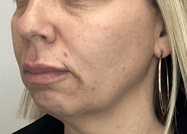 Before Image: Facial Fillers - left-front-oblique