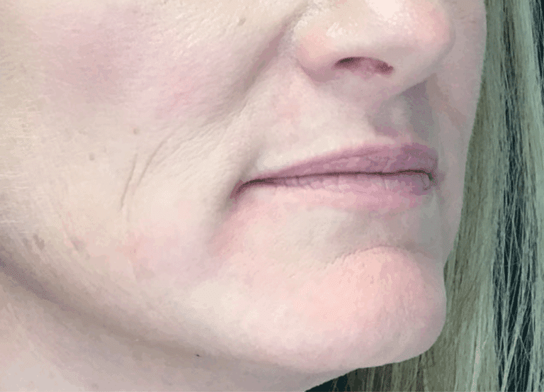 Before Image: Lip Filler - right-front-oblique