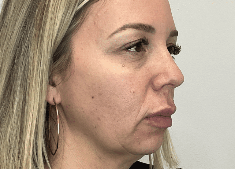 Before Image: Facial Fillers - right-front-oblique