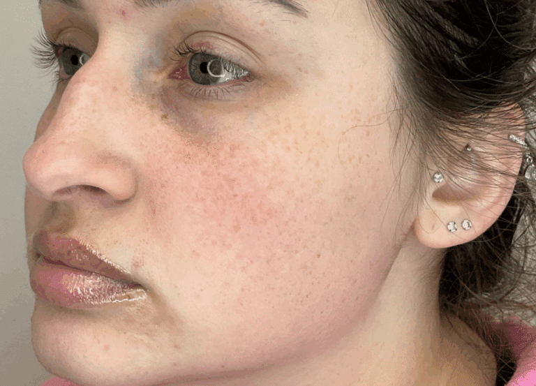 Before Image: Jawline Filler - left-front-oblique