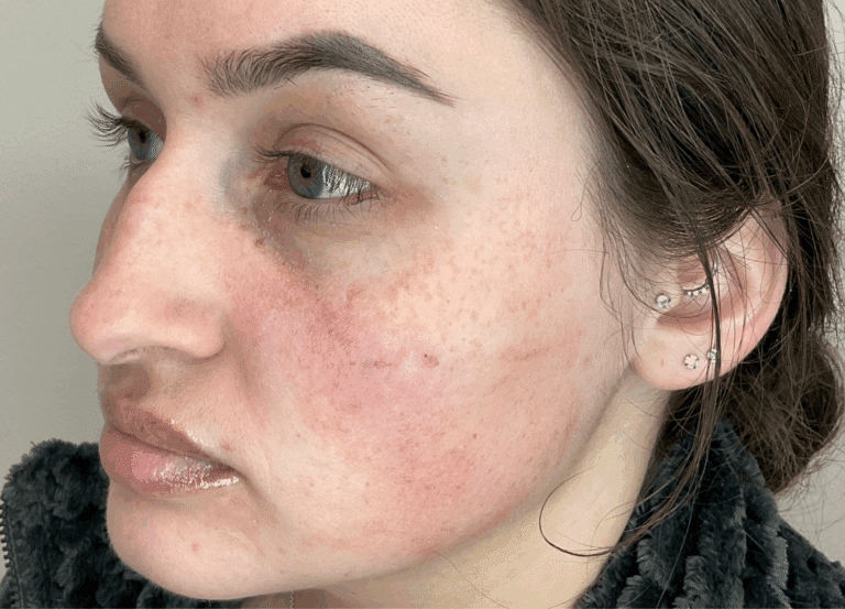 After Image: Jawline Filler - left-front-oblique