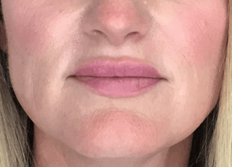 After Image: Lip Filler - front