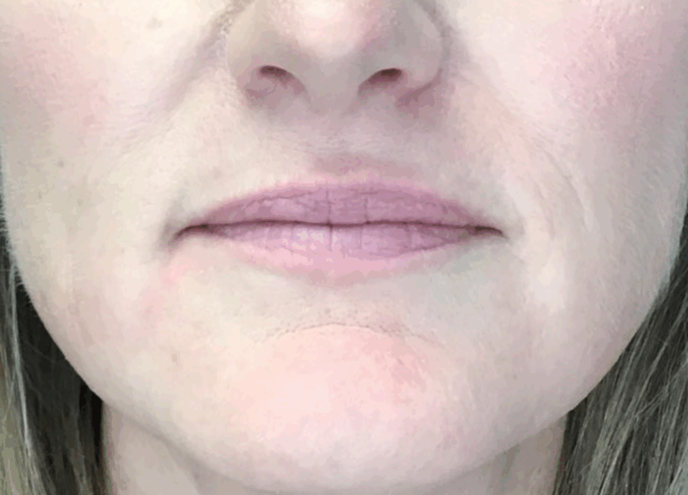 Before Image: Lip Filler - front