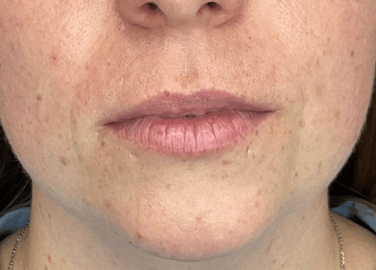 Before Image: Lip Filler - front