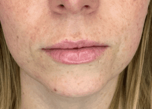 After Image: Lip Filler