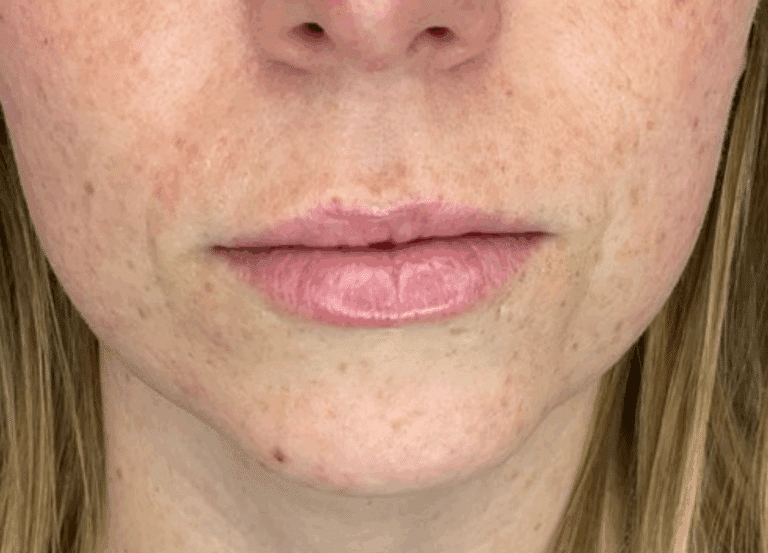 After Image: Lip Filler - front