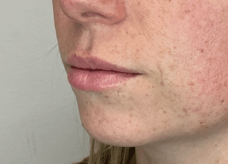 After Image: Lip Filler - left-front-oblique