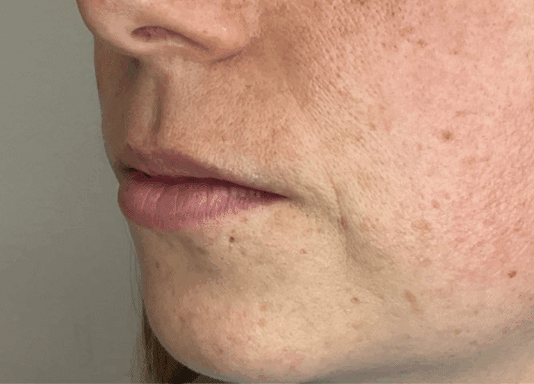 Before Image: Lip Filler - left-front-oblique