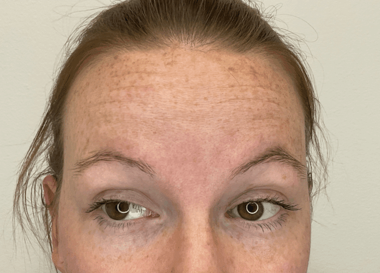 Before Image: Botox - front