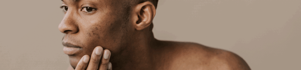 acne header