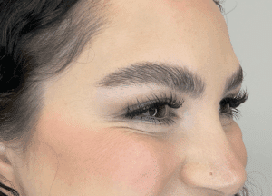 After Image: Botox: Crow’s Feet