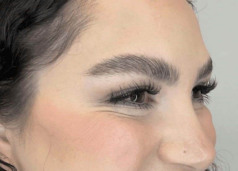 After Image: Botox: Crow’s Feet - right-front-oblique