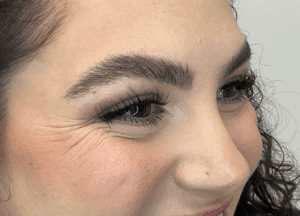 Before Image: Botox: Crow’s Feet