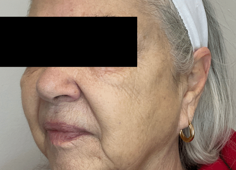 After Image: PicoSure Laser - left-front-oblique