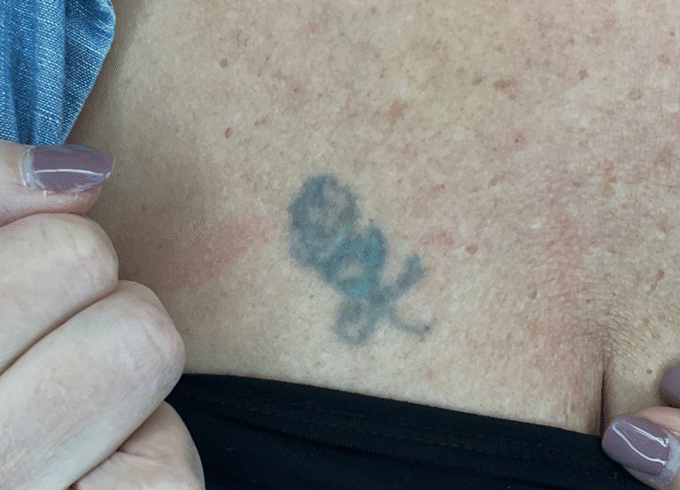 Before Image: Tattoo Removal - front