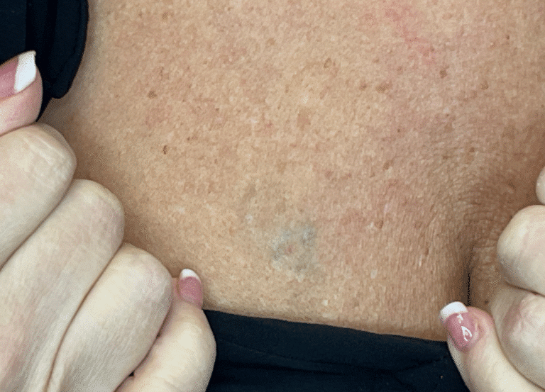 After Image: Tattoo Removal - front