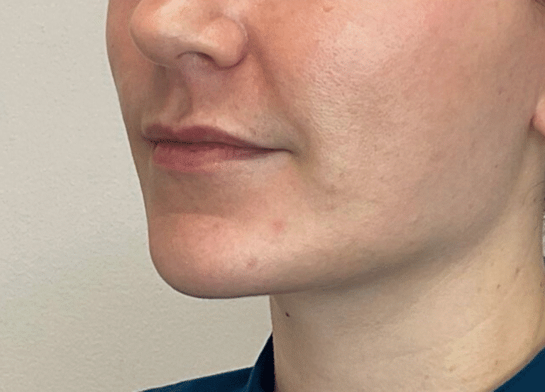 Before Image: Lip Filler - left-front-oblique