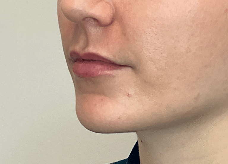 After Image: Lip Filler - left-front-oblique