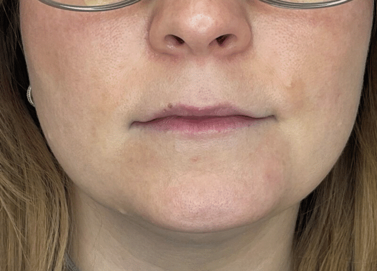 Before Image: Lip Filler - front