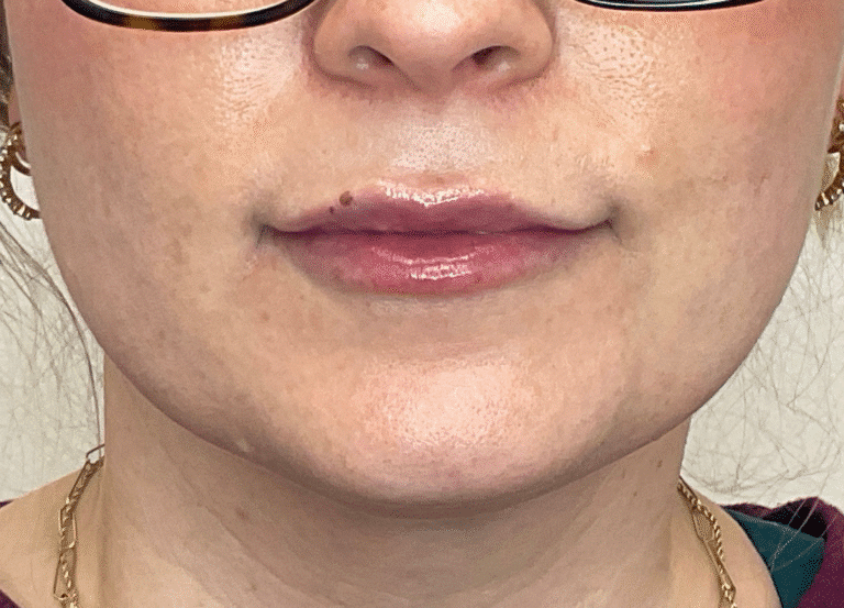 After Image: Lip Filler - front